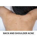 How to get Rid of Back and Shoulder Acne